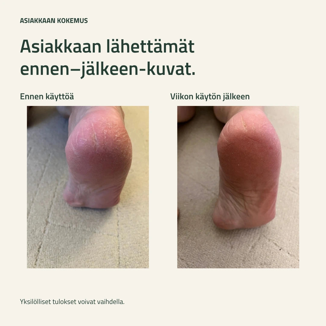 Asiakkaan kuvat ennen jalkavoiteen käyttöä ja viikon käytön jälkeen